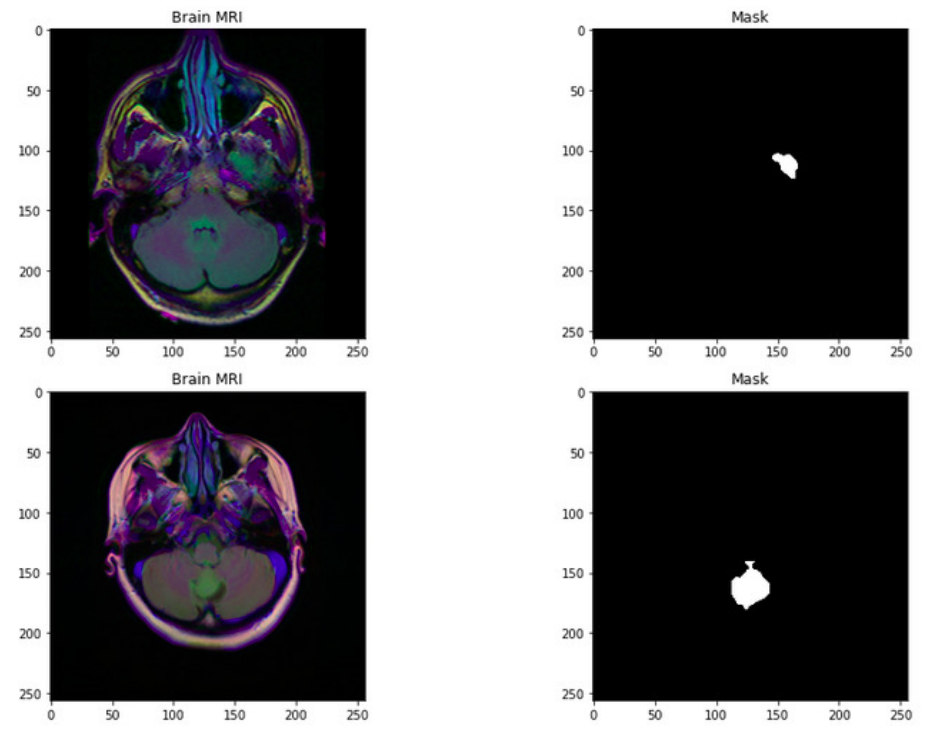 Brain tumor segmentation preview