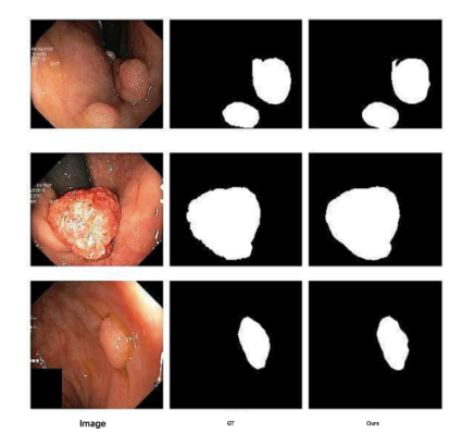 Polyp segmentation preview
